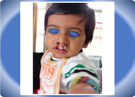 CLEFT LIP